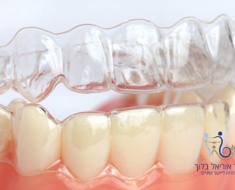יישור שיניים ללא גשר מטופל מרפאת ד"ר אוריאל בלוך קשת איויזליין